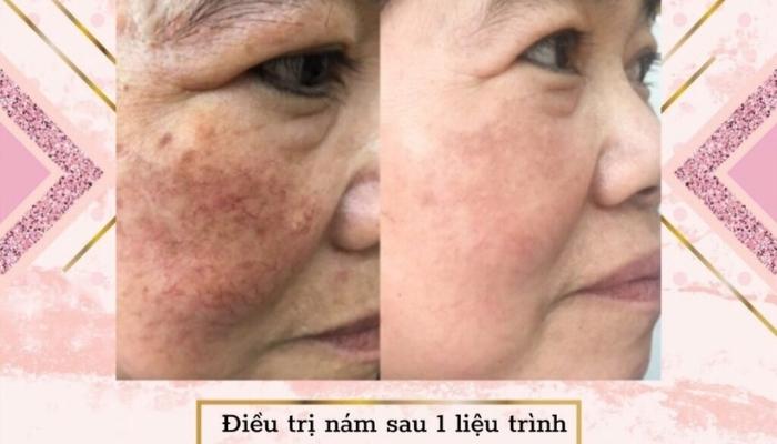 enbi-spa điều trị nám hiệu quả sau 1 tuần