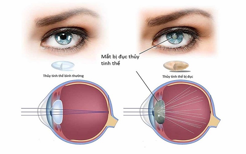 dấu hiệu nhận biết bệnh đục nhân mắt