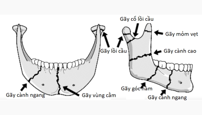 Chấn thương vùng hàm mặt là gì? 